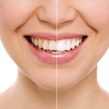 Midtown Teeth Whitening
